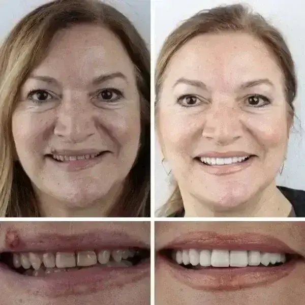 -Ends Today: 70% OFF! ⏰HazyGalaxy™ Medical Full Denture with Strong Suctiond Custom-Fit Full Functional Dentures🦷