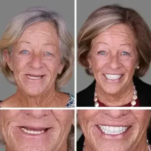 -Ends Today: 70% OFF! ⏰HazyGalaxy™ Medical Full Denture with Strong Suctiond Custom-Fit Full Functional Dentures🦷