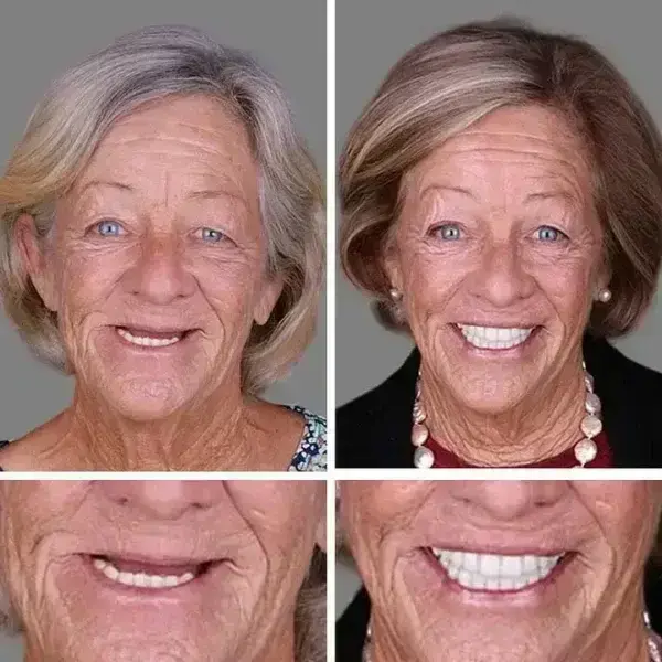 -Ends Today: 70% OFF! ⏰HazyGalaxy™ Medical Full Denture with Strong Suctiond Custom-Fit Full Functional Dentures🦷