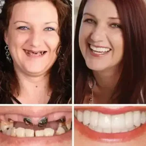 -Ends Today: 70% OFF! ⏰HazyGalaxy™ Medical Full Denture with Strong Suctiond Custom-Fit Full Functional Dentures🦷