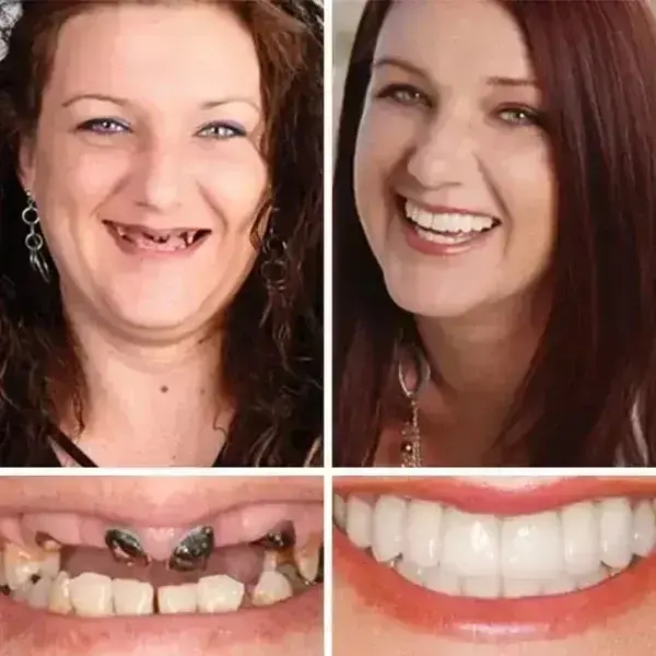 -Ends Today: 70% OFF! ⏰HazyGalaxy™ Medical Full Denture with Strong Suctiond Custom-Fit Full Functional Dentures🦷