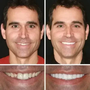 -Ends Today: 70% OFF! ⏰HazyGalaxy™ Medical Full Denture with Strong Suctiond Custom-Fit Full Functional Dentures🦷