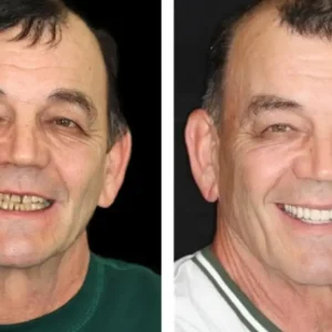 HZA™ Custom-Fit Premium Dentures – Full Set