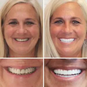 HZA™ Custom-Fit Premium Dentures – Full Set