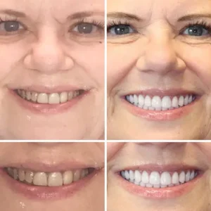 HZA™ Custom-Fit Premium Dentures – Full Set