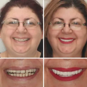 HZA™ Custom-Fit Premium Dentures – Full Set