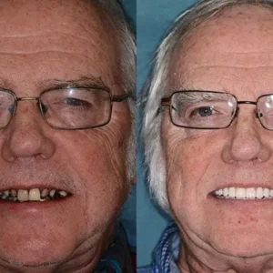 HZA™ Custom-Fit Premium Dentures – Full Set
