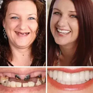 HazyGalaxy™ Soft Silicone Carbon Ceramic Teeth, Strong and White – Natural Look, Comfortable Fit